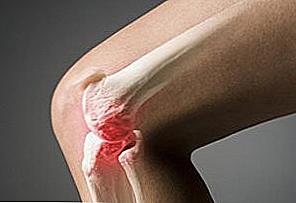 Остеоартрит на коляното за домашно лечение / Красота и здраве