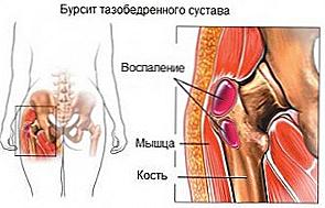 Příznaky a léčba kyčelní bursitidy / Krása a zdraví