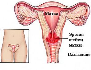 Cervikální eroze - léčba doma / Krása a zdraví