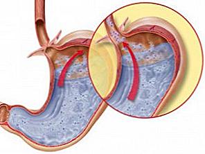 Symptomy a léčba gastroesofageálního refluxního onemocnění / Krása a zdraví