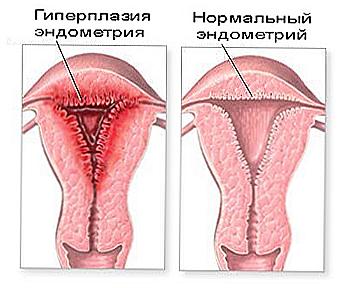 Hyperplázie endometriální léčby lidových léků / Krása a zdraví