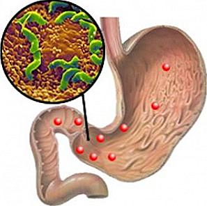 Léčba lidských léků Helicobacter pylori / Krása a zdraví