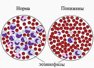 Намалени еозинофили / Красота и здраве