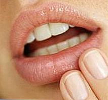Bity w kącikach ust u dorosłych i leczenie / Piękno i zdrowie