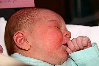 Staphylococcus aureus u niemowląt / Dom i rodzina